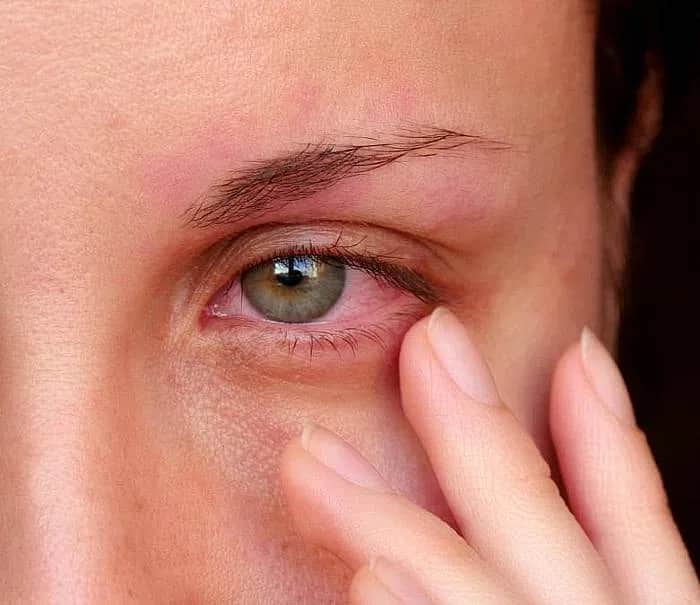 Swędzą Cię oczy? Alergia na płyn do soczewek co robić?