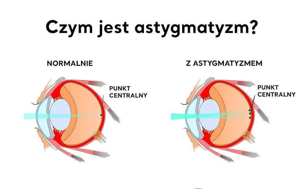 Astygmatyzm: okulary czy soczewki? Porównaj i wybierz mądrze!