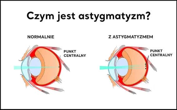 Astygmatyzm: Skąd się bierze? Geny, urazy, choroby wszystko o nim